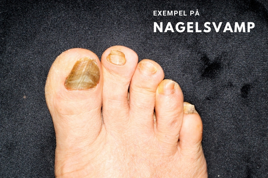 Nagelsvamp på flera tår, höger fot